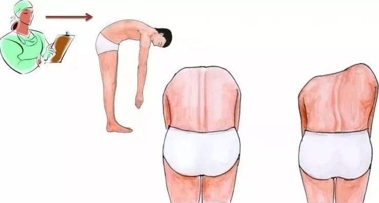 脊柱側(cè)彎早發(fā)現(xiàn)，早治療