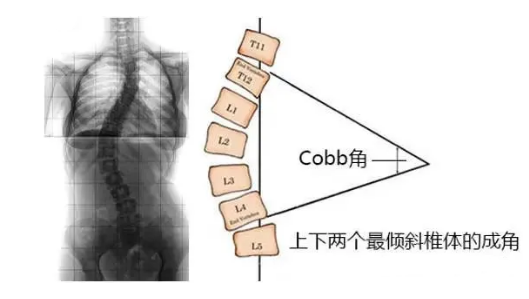 脊柱側(cè)彎角度怎么測量？