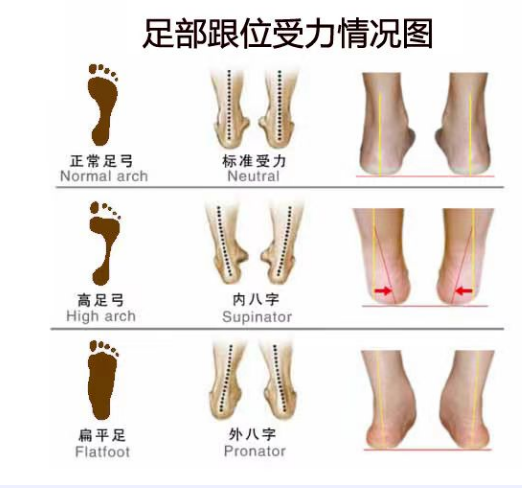 扁平足和脊柱側(cè)彎之間有關(guān)聯(lián)嗎？