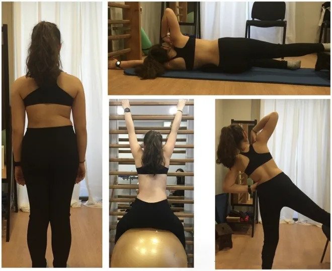 佩戴脊柱側(cè)彎矯形器后的運動治療