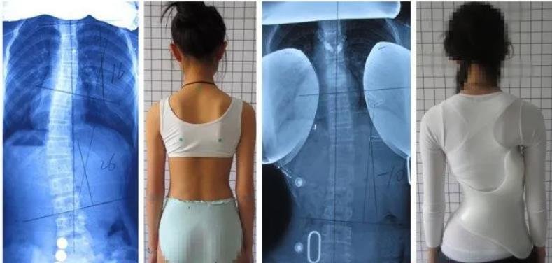 佩戴脊柱側(cè)彎矯形器后的運動治療